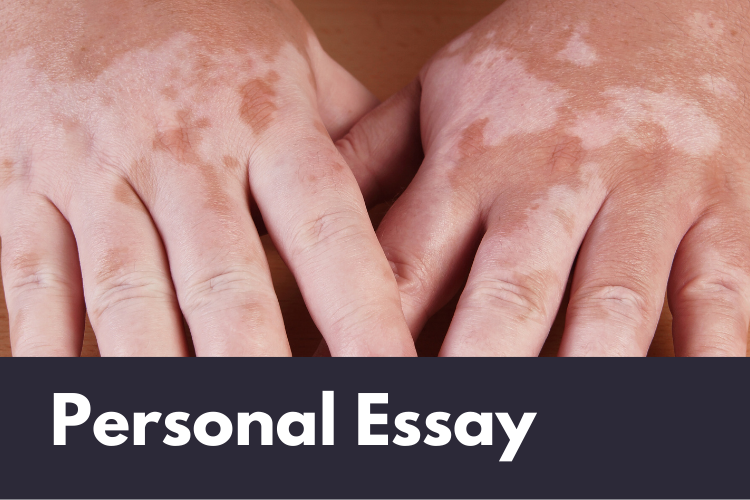 A set of tan coloured hands, covered with white patches from vitiligo. Tagged as "Personal Essay"
